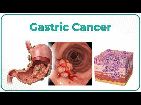 Gastric Cancer: Etiology, Risk Factors, Clinical features, Pathology, Diagnosis & Treatment - USMLE