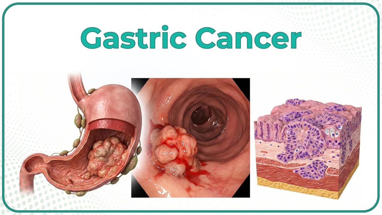 Gastric Cancer: Etiology, Risk Factors, Clinical features, Pathology, Diagnosis & Treatment - USMLE