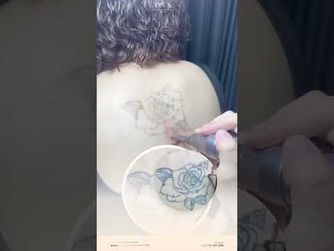 Laser Tattoo Removal in Poipet