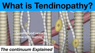 Tendinopathy Continuum Explained