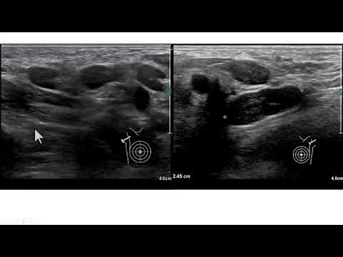 Múltiplos linfonodos axilares em uma paciente com infecção pelo HIV. Como classificar?