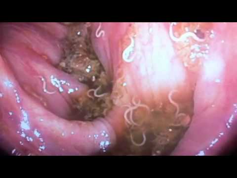 A pinwormák elleni gyógyszer hatásának ideje
