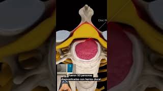 Hernia de disco. ¿Se puede reabsorber