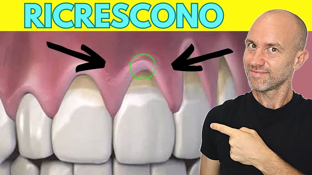 Come far ricrescere le gengive ritirate risolvere la retrazione gengivale a casa