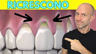 Come far ricrescere le gengive ritirate risolvere la retrazione gengivale a casa