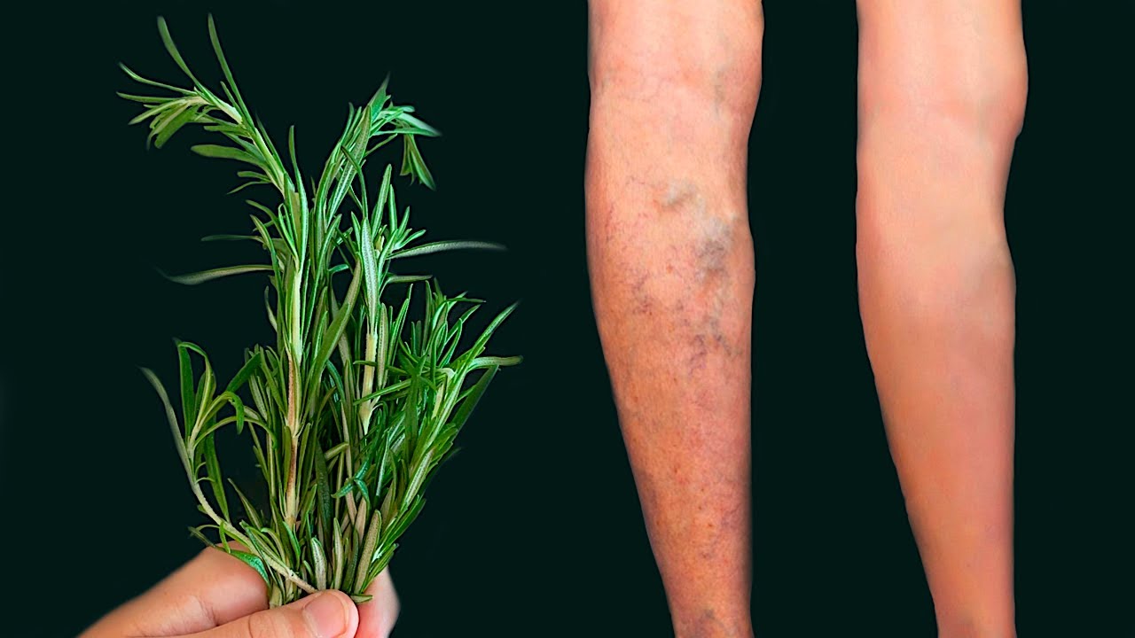 Unglaublich! Mit Rosmarin Krampfadern loswerden! Dieser Schatz sollte in jedem Haus sein