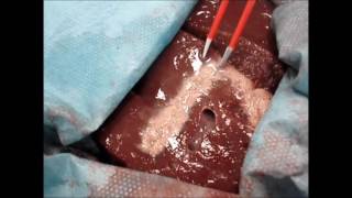 EHT method | nonStick flush and maXium®