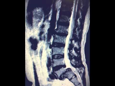 Sciatica e mal di schiena sono la stessa cosa Esercizi per la flessibilità del ginocchio