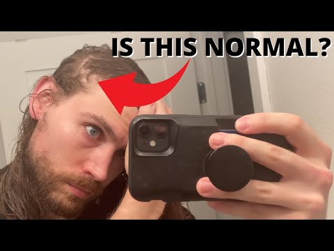 YouTube video about: Can see my scalp under direct light?