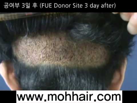 1450FU's. FUE Hair Transplantation by Dr. Moh
