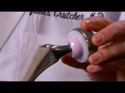Metal on Metal Hip Implants: A Contested Innovation | Vibepedia