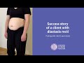 Success story of a client with diastasis recti