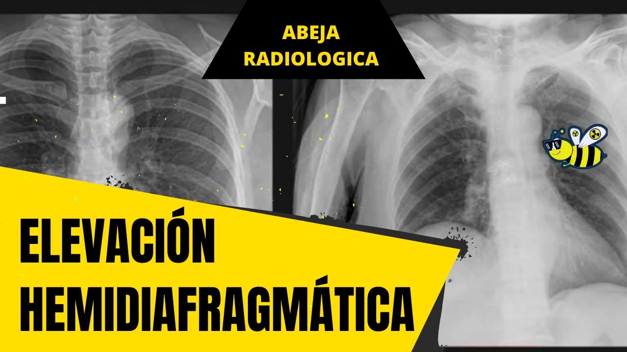 ⚠️🟡➡️ Elevación Hemidiafragmática ⚠️🟡➡️