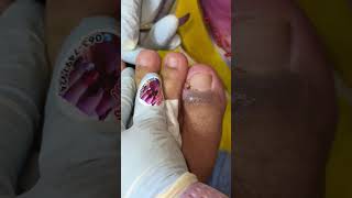 Ep_8188 Ingrown toenail removal 👣 Cutting your nails too short...why does it hurt? 😄 (clip from T...