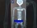 The 2,000+ Year-Old Nazca Mummy's Secret Metal Implants