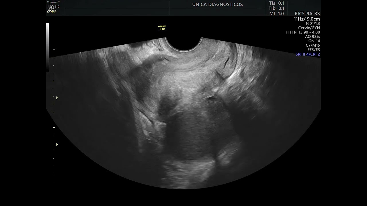 Endometrioma em ambos ovários