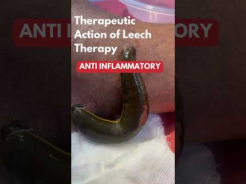 Leech Therapy Benefits| Leech Therapy at Easy Ayurveda Hospital