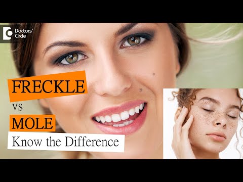 What's the difference between a freckle and a mole? - Dr. Nischal K  | Doctors' Circle