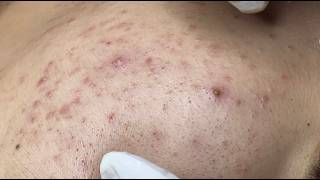 Blackhead & Whitehead Extractions #HoangMySpa199