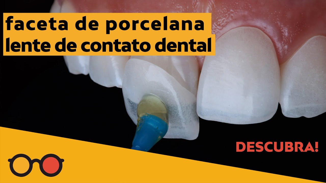Watch Now Lentes de contato dental: do?i para colocar Como é o desgaste nos dentes para faceta de porcelana Lentes de contato dental: do?i para colocar Como é o desgaste nos dentes para faceta de porcelana