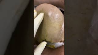 COVID 19 (SARSCO-2) Autopsy