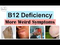 Vitamin B12 Deficiency Weird Symptoms Part 2 Types Of Headaches Gastrointestinal And Others