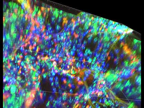 PLISH In situ hybridization of thick human lung tissue For SFTPC, MIR29-1, and AXIN2