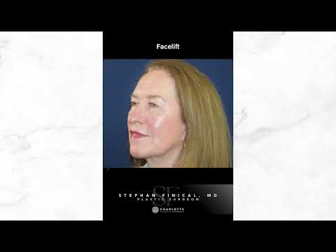 SMAS Facelift Before and After | Natural Facelift Results in Charlotte, NC