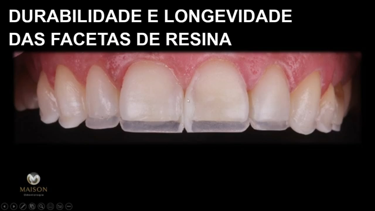 Quais são os Cuidados para Manter as Facetas de Resina por Muito Tempo?