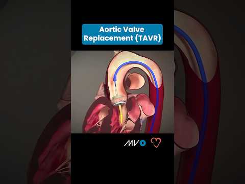 🫀Transcatheter Aortic Valve Replacement (TAVR) 🫀 #anatomy #doctor