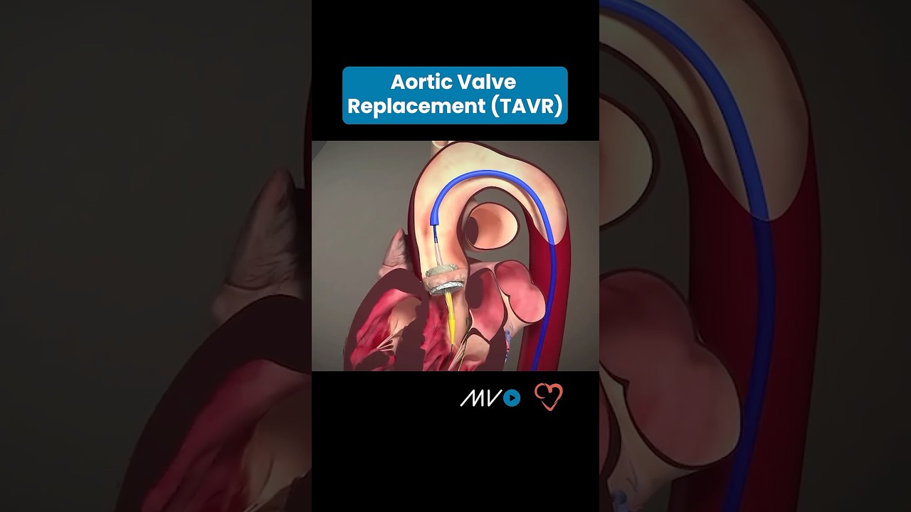 🫀Transcatheter Aortic Valve Replacement (TAVR) 🫀 #anatomy #doctor