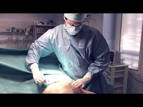 download lagu mp3 mp4 Penoplastie Suisse, download lagu Penoplastie Suisse gratis, unduh video klip Penoplastie Suisse