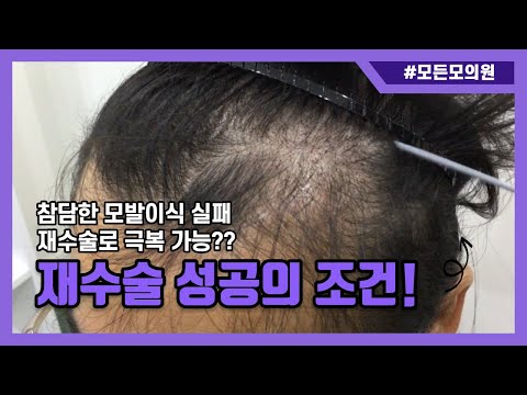 모발이시 재수술시 무시하면 낭패 보는 것들!