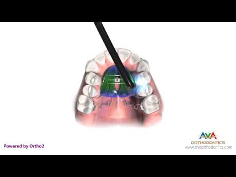 Orthodontic Space Management - Pendex Appliance