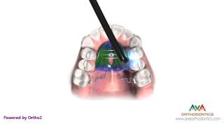 preview picture of video 'Pendulum - Orthodontic Device'