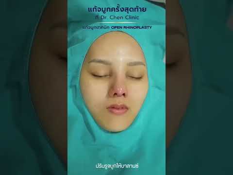 ปรับจมูกทรงแข็ง ให้ดูละมุน และ ปรับรูจมูกให้เท่ากันมากขึ้น