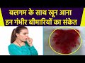 बलगम के साथ खून आना इन गंभीर बीमार‍ियो