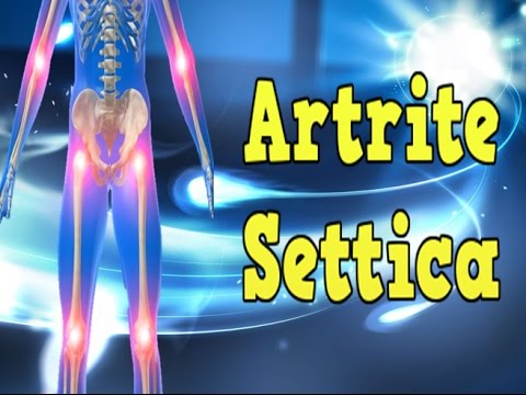 Condrosi sintomi di trattamento della colonna vertebrale cervicale Cosa fare se le articolazioni dellanca doloranti durante la gravidanza