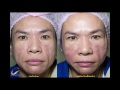 ร้อยไหม