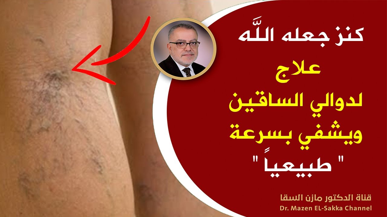 كنز جعله الله علاج دوالي الساقين ويشفي بسرعة طرق طبيعية لمحاربة الأوردة العنكبوتية ودوالي الساقين