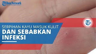 Kesusupan, Kondisi Serpihan Kayu Kecil atau Duri yang Terjebat di Kulit dan Bisa Sebabkan Infeksi