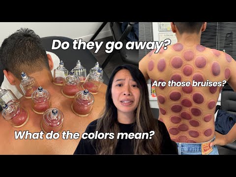 What They DON'T Tell You About Cupping Marks...