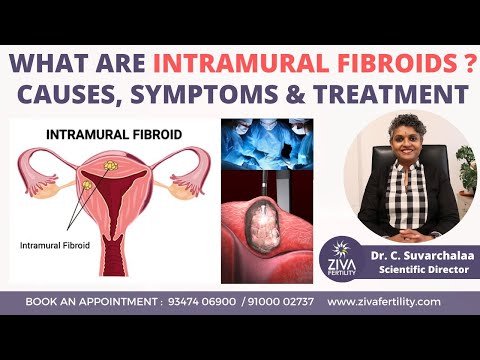 Intramural Fibroid : Causes, Symptoms and Treatment || Dr C Suvarchalaa || ZIVA Fertilityy