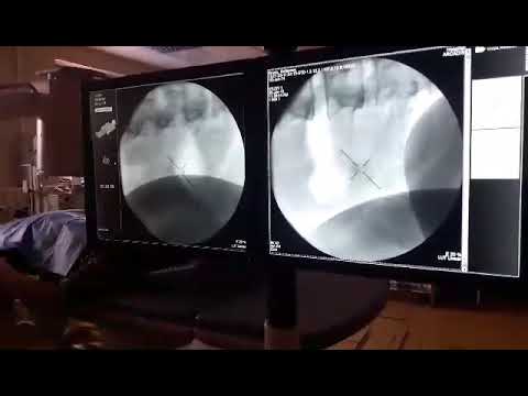 Gazeta Shneta - Thyerja e gureve ne Urologji-QKUK