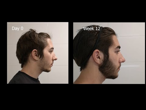 Minoxidil Beard Growth - 3 Month Transformation - Timelapse (BEFORE and AFTER)