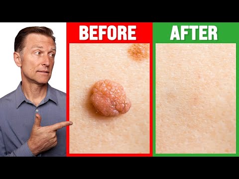 How to Rid Skin Tags and Warts Within 24 Hours - Dr. Berg on Skin Tag Removal