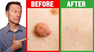 How to Rid Skin Tags and Warts Within 24 Hours - Dr. Berg on Skin Tag Removal