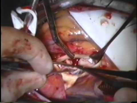 Repair of the Common Type of Bicuspid Aortic Valve with Insufficiency