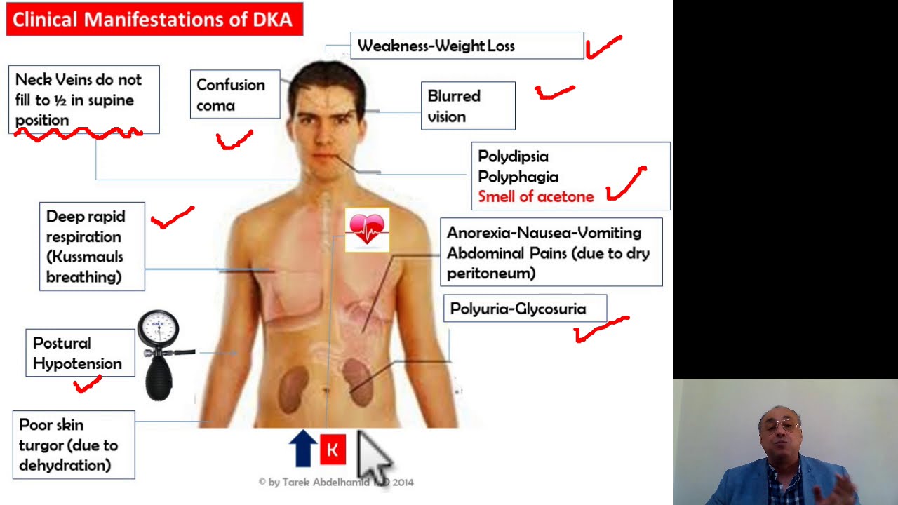 Diabetes Mellitus (4) Quick Review
