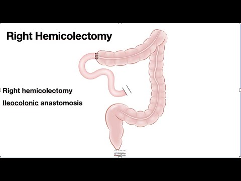 HCC 1475 10i  Surgical Anatomy Right hemicolectomy